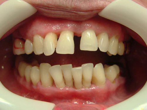 Расхождение зубов при пародонтозе