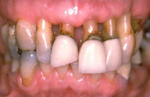 Выпадение зубов при пародонтозе