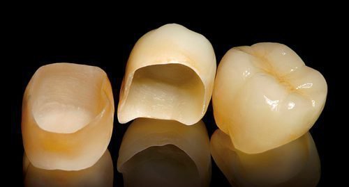 Коронки на коренные зубы