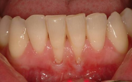 Опущение десен верхнего ряда зубов