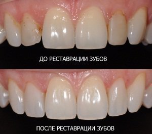 Реставрация эмали передних зубов