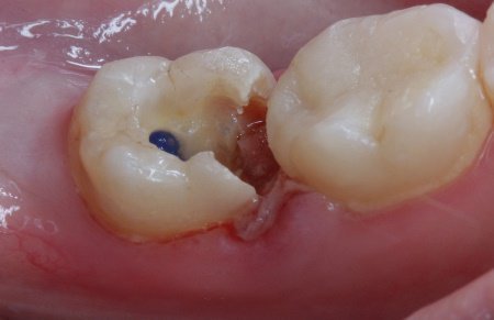 Мышьяковая паста в зубе