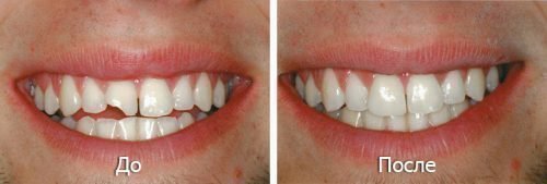 Реставрация сколотого зуба