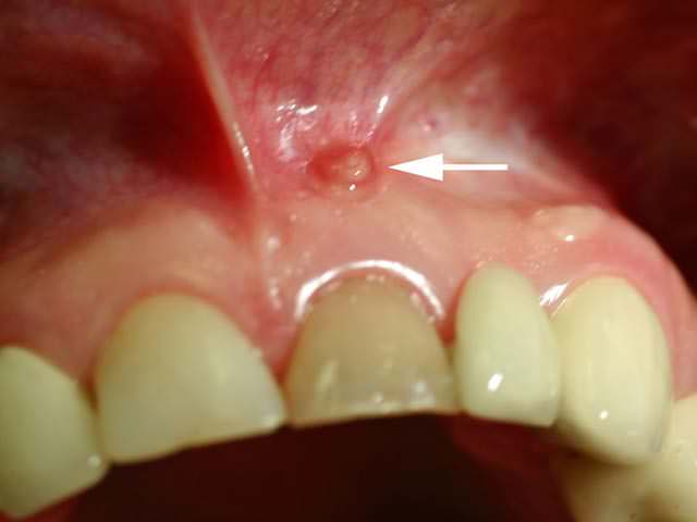 Давление в зубе