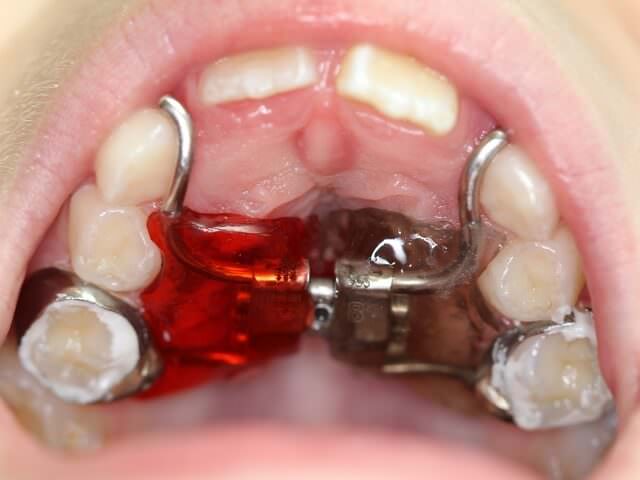 Несъемные конструкции в ортодонтии
