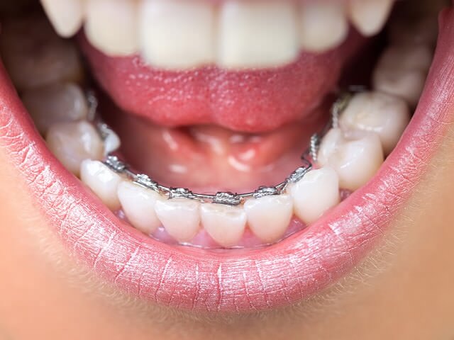 Брекеты на обратной стороне зубов