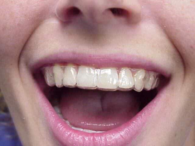 Капы на зубах после брекетов