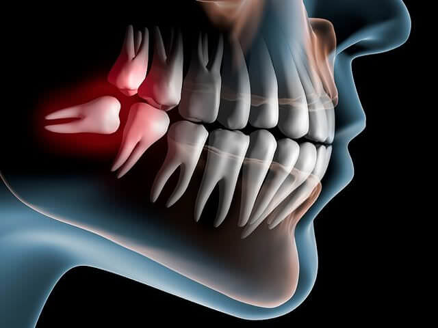 Схематичное изображение челюсти с ретинированным (дистопированного) зубом