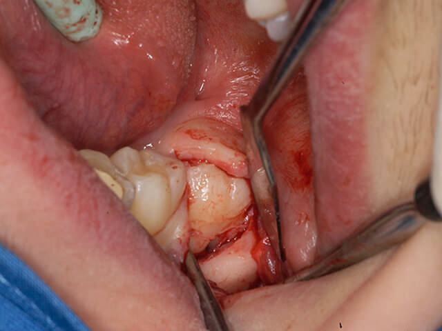 Проводится удаление ретинированного дистопированного зуба