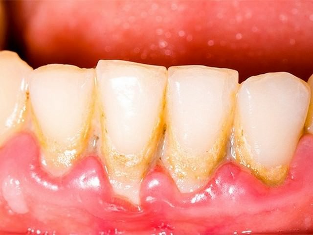 Зубной камень на поверхности зубов