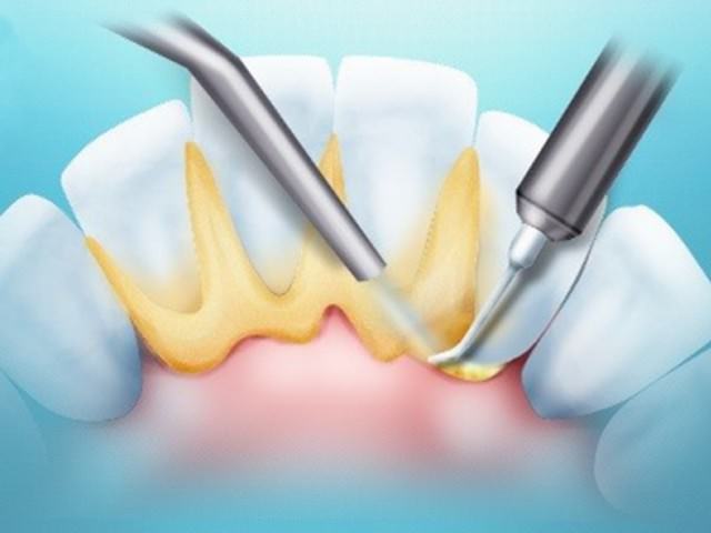 Схематично показан процесс устранения зубного камня с зубов
