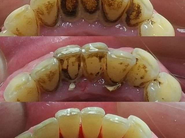 Процесс чистки зубного налета