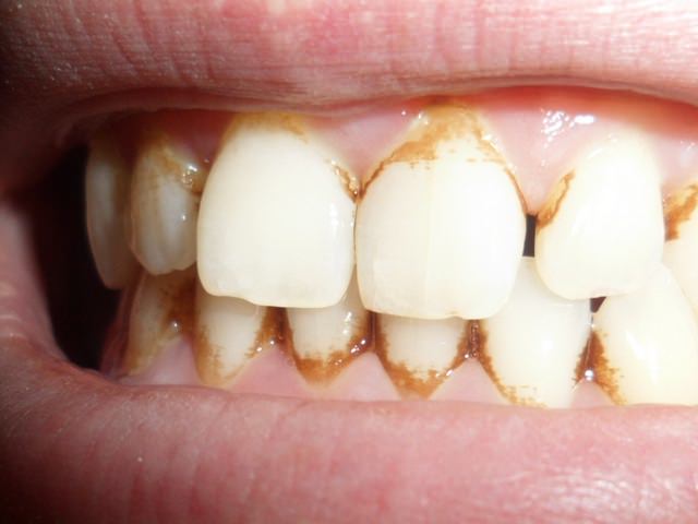 Зубной налет и камень на внешней стороне зубов