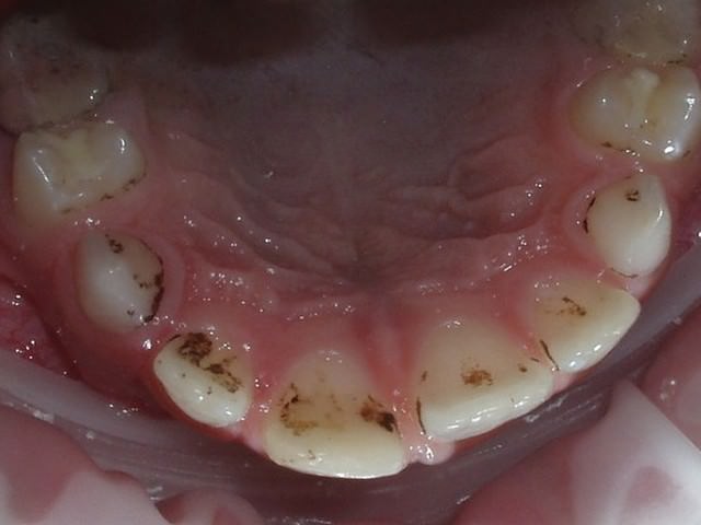 Зубной камень на внутренней стороне зубов