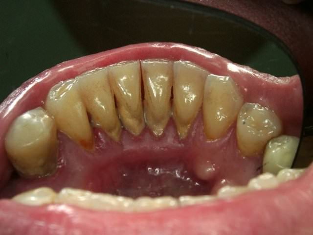 Зубной камень на внутренней стороне зубов человека