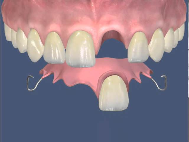Схематично изображена установка съемного зубного протеза