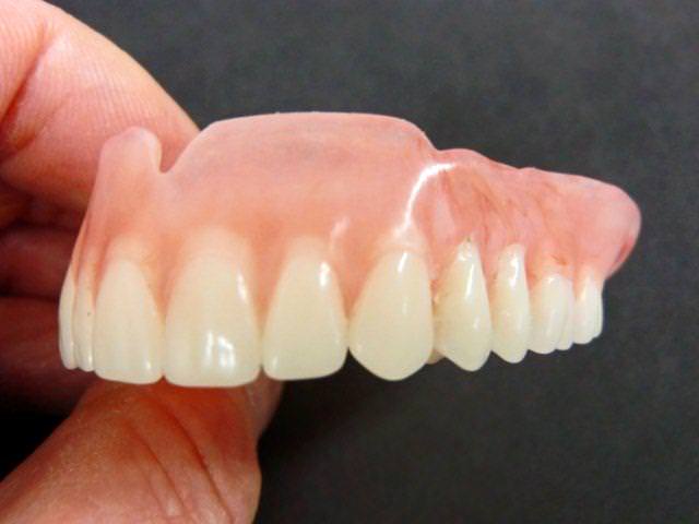 Протез для верхних передних зубов