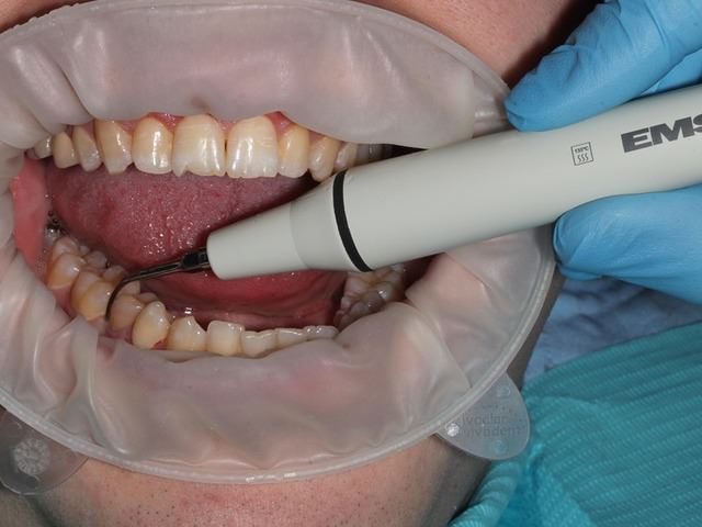 Обработка зубов