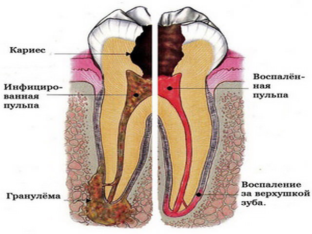 болезни зуба