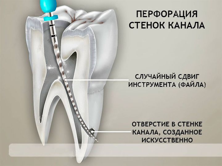 Перфорация зубного корня