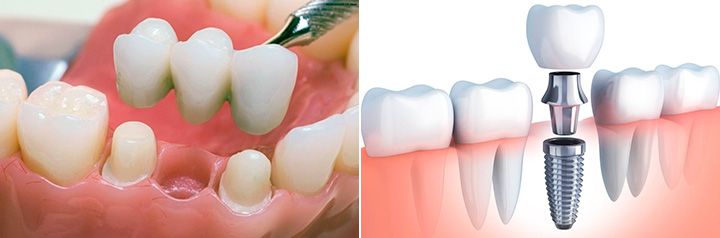 Установка коронки на зуб и на имплант