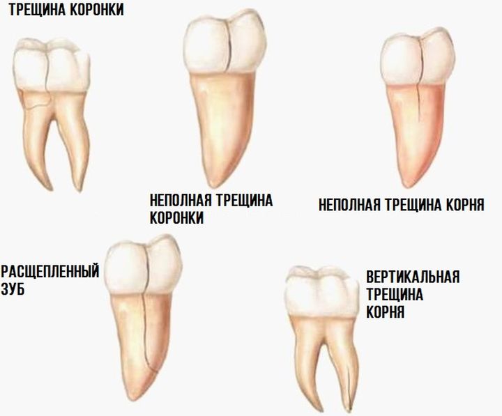 Виды зубных трещин
