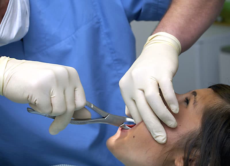 Что делать, если кровоточит десна после удаления зуба