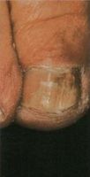 Гиперкератоз и онихолизис ногтевого ложа большого пальца ноги