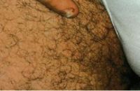 Паховый участок пациента у которого поражены несколько ногтевых пластинок грибком Trichophyton rubrum