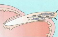 Схематическое изображение внедрения грибка в среднюю (внутреннюю) часть ногтевой пластинки