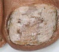 этот же пациент. Поражения ногтя вызванные грибком Aspergillus candidus