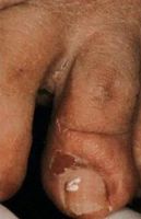 Дерматомикоз межпальцевых промежутков стоп у пациента с поверхностный ногтевым грибком