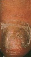 Гиперкератоз ногтевой пластины в связи с дистальным боковый грибком ногтей возникший после обрезания ногтя