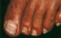 Молочно-белый цвет ногтевых пластинок при поражении внутренней части ногтя грибком. Гиперкератоз и онихолизис (разрушение) отсутствуют