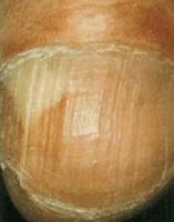 проксимальный подногтевой грибок - видно размягчение ногтя в проксимальной части