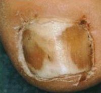  Проксимальный подногтевой грибок с переходом на кожу пальца вызванный Fusarium  sp. Обратите внимание на размягчение (лейконихию) и околоногтевое воспаление