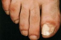 Проксимальный подногтевое поражение грибком вызванное Fusarium sp. Обратите внимание на покраснение кожи возле ногтя.