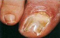 подногтевое поражение вызванное Aspergillus flavus. Обратите внимание на воспаление вокруг ногтя и гнойные выделения