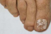 Белый поверхностный грибок ногтей вызванный Aspergillus candidus