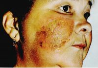 Острый дерматит на лице  появление пузырьков и эрозий