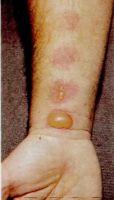 Острый дерматит - появление пузырей на коже.