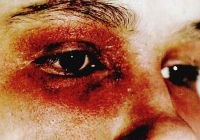 Проявления острого дерматита на коже вокруг глаз