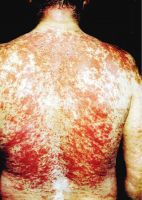 Распространенный дерматит на спине