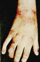 Диффузный нейродермит на коже руки