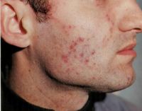 высыпания на лице больного туберкулёзом кожи