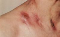 глубокие рубцы на грудной клетке у больного туберкулёзом кожи