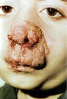 туберкулёзная волчанка кожи у ребенка