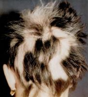 Витилиго на волосистой части головы