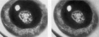 Передняя полярная катаракта (стереофото).