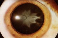 Звездчатая катаракта при пигментной дистрофии сетчатки.